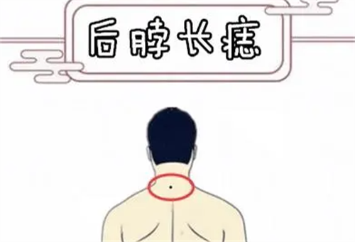 男人横财痣长哪里 男人身上哪里的痣是横财痣