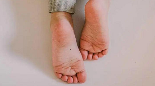 脚心有痣的女人代表什么意思 脚心有痣的人命运如何