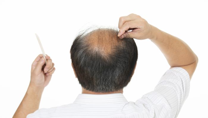 梦见自己秃头是什么意思 梦见自己秃头是什么预兆
